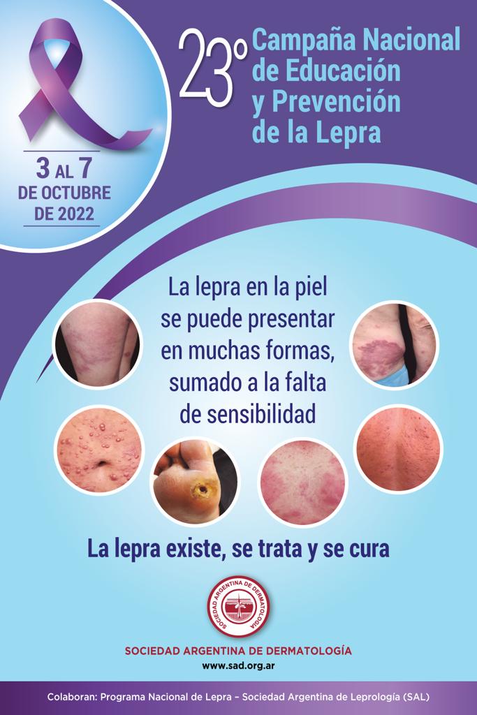 Del 3 al 7 de Octubre 23 Campaña de Educación y prevención de la Lepra.